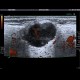 Pleomorphic adenoma of parotid gland: US - Ultrasound